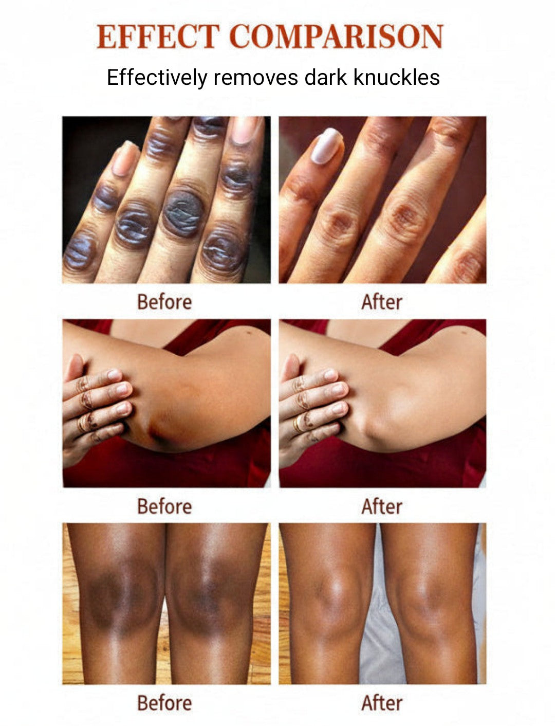 MOOYAM Dark Knuckle Whitening Serum –  50 ml